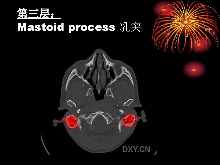 第三层： Mastoid process 乳突 