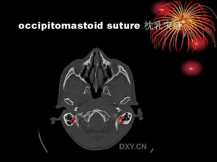 occipitomastoid suture 枕乳突缝 