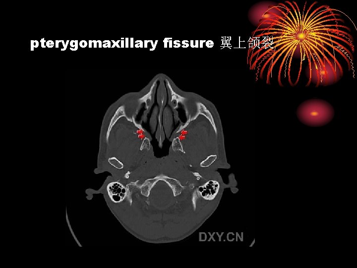 pterygomaxillary fissure 翼上颌裂 