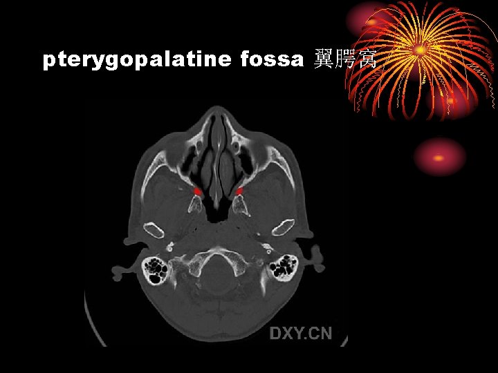 pterygopalatine fossa 翼腭窝 