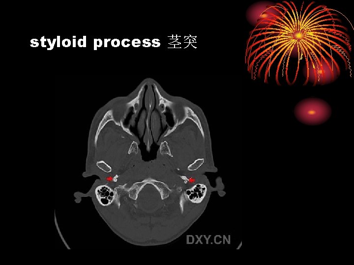 styloid process 茎突 