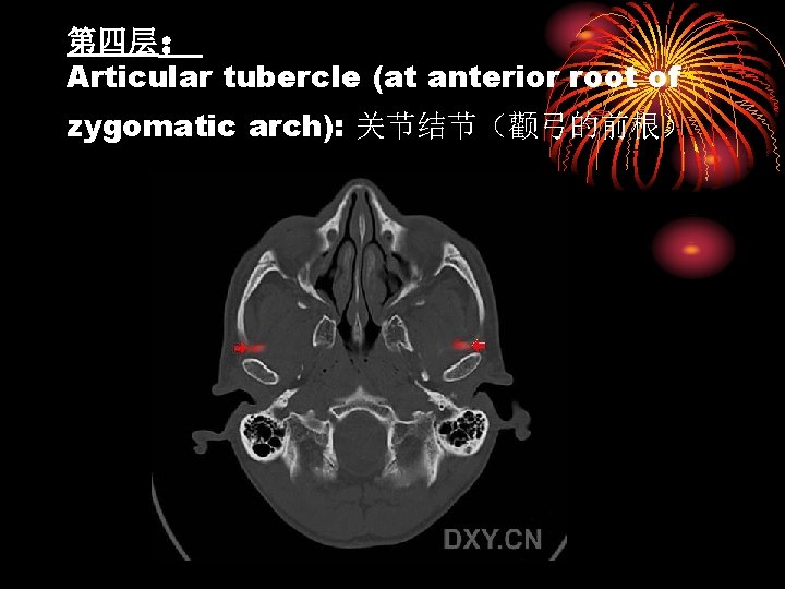 第四层： Articular tubercle (at anterior root of zygomatic arch): 关节结节（颧弓的前根） 