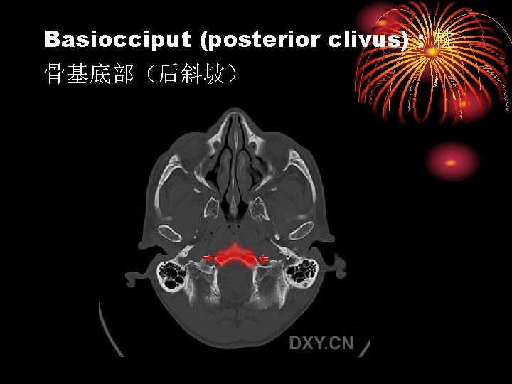 Basiocciput (posterior clivus) : 枕 骨基底部（后斜坡） 