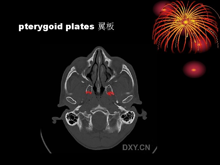pterygoid plates 翼板 