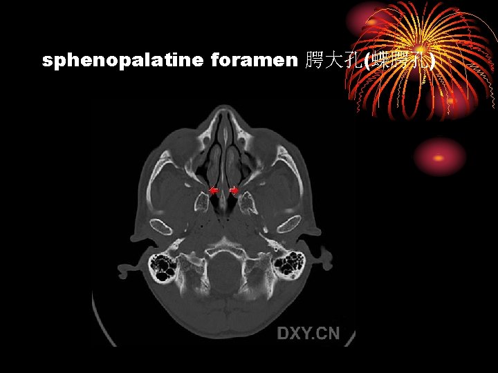 sphenopalatine foramen 腭大孔(蝶腭孔) 