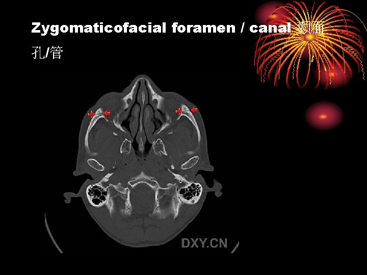 Zygomaticofacial foramen / canal 颧面 孔/管 