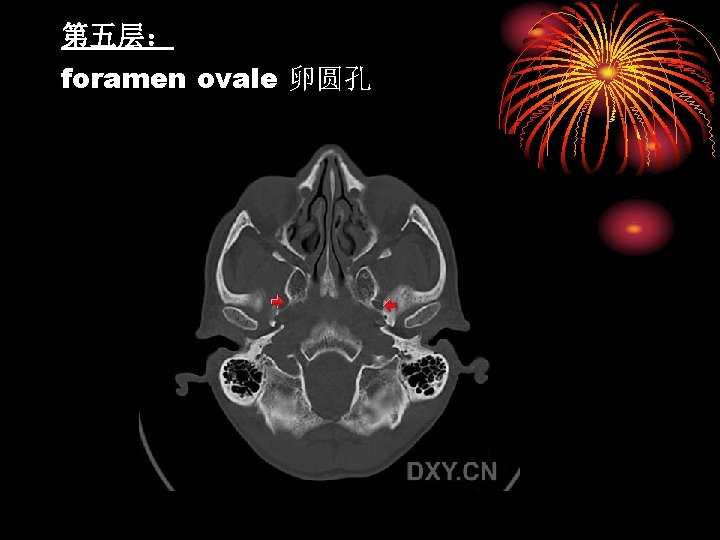 第五层： foramen ovale 卵圆孔 