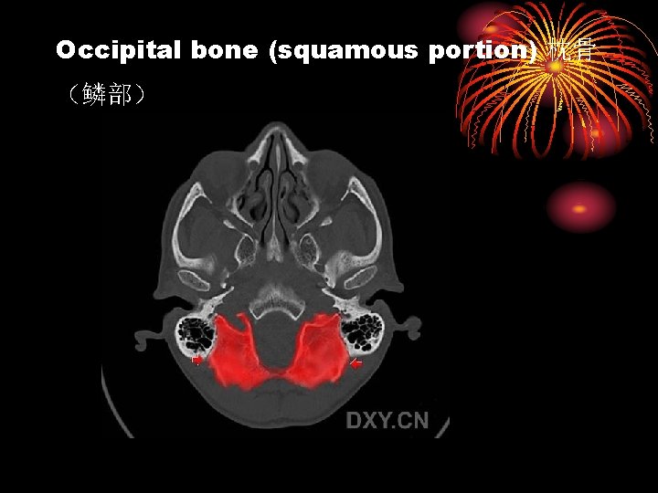 Occipital bone (squamous portion) 枕骨 （鳞部） 
