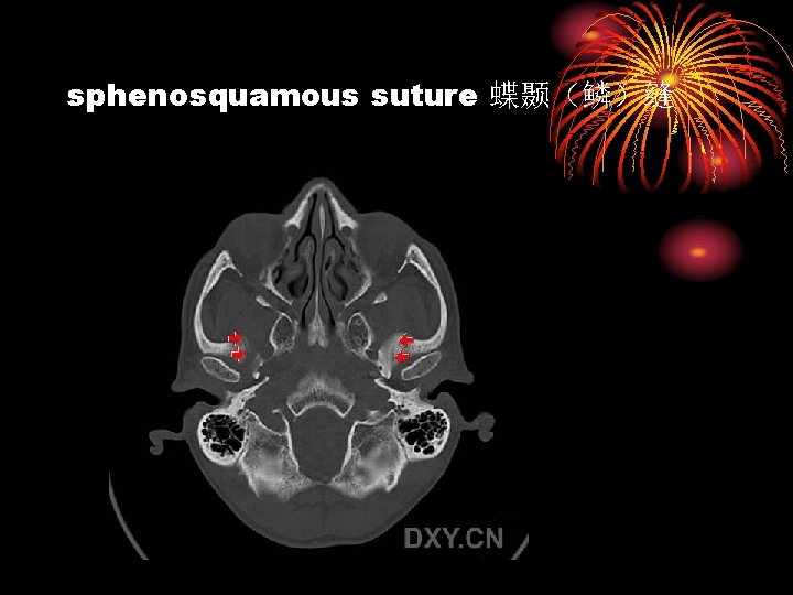 sphenosquamous suture 蝶颞（鳞）缝 