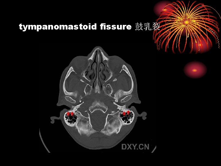 tympanomastoid fissure 鼓乳裂 