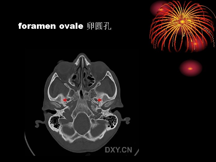 foramen ovale 卵圆孔 