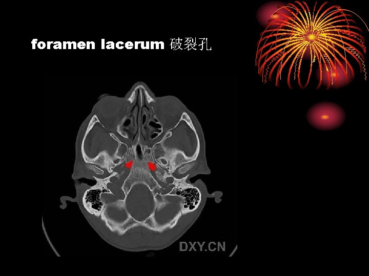 foramen lacerum 破裂孔 