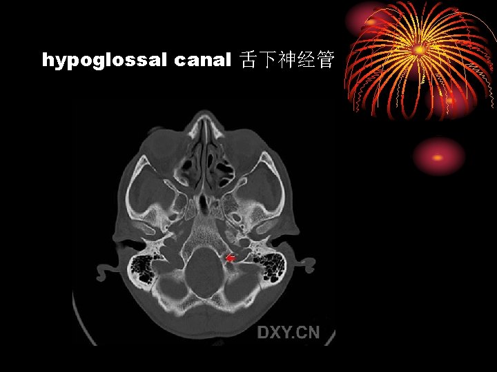 hypoglossal canal 舌下神经管 