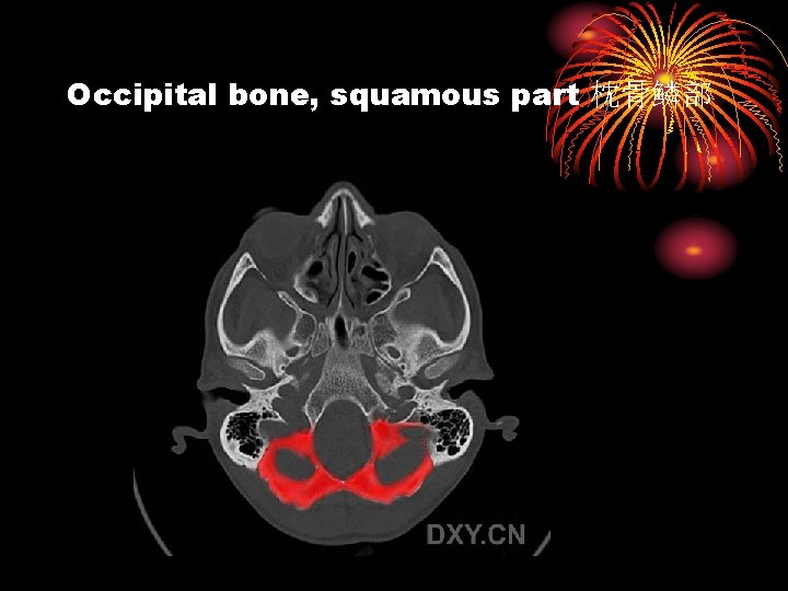 Occipital bone, squamous part 枕骨鳞部 
