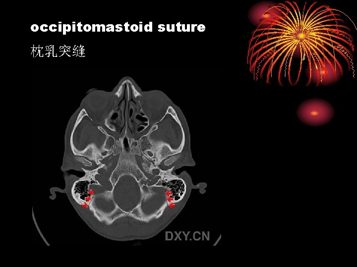 occipitomastoid suture 枕乳突缝 