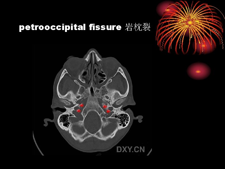 petrooccipital fissure 岩枕裂 