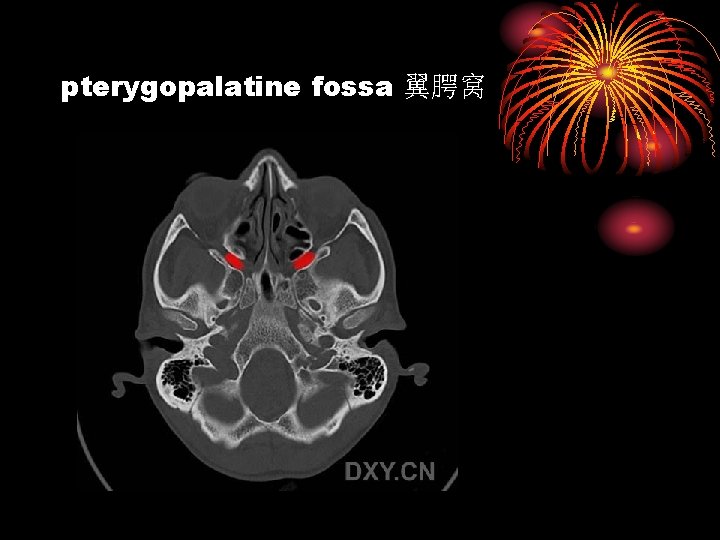 pterygopalatine fossa 翼腭窝 