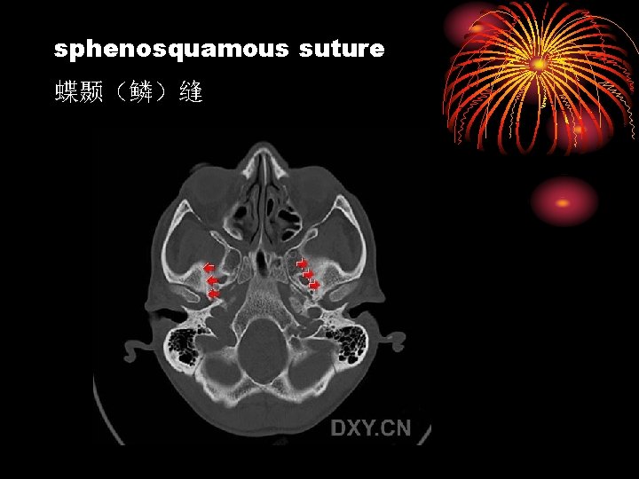 sphenosquamous suture 蝶颞（鳞）缝 