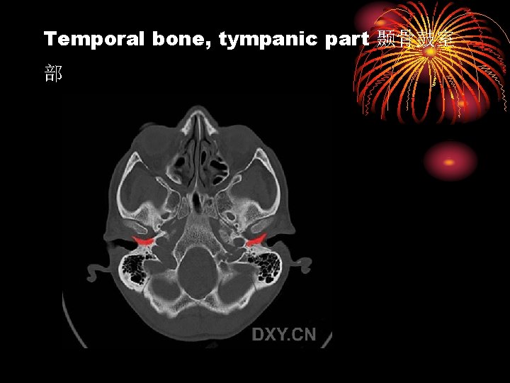 Temporal bone, tympanic part 颞骨鼓室 部 