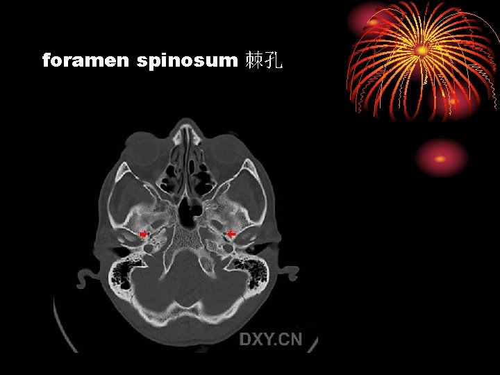 foramen spinosum 棘孔 