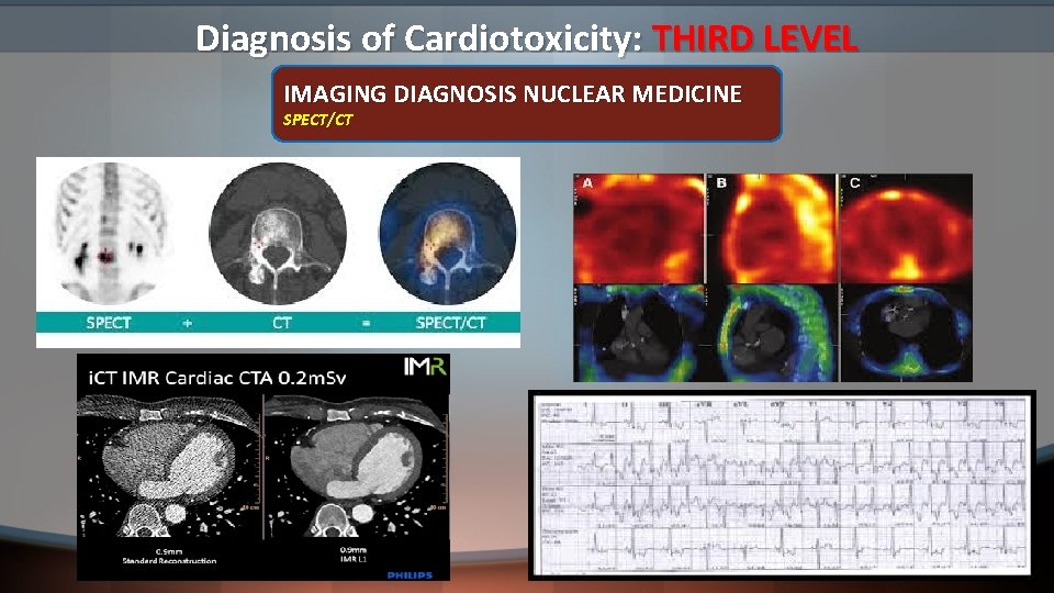Diagnosis of Cardiotoxicity: THIRD LEVEL IMAGING DIAGNOSIS NUCLEAR MEDICINE SPECT/CT 14 