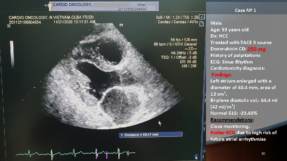 Case Nº 1 Male Age: 53 years old Dx: HCC Treated with TACE 5