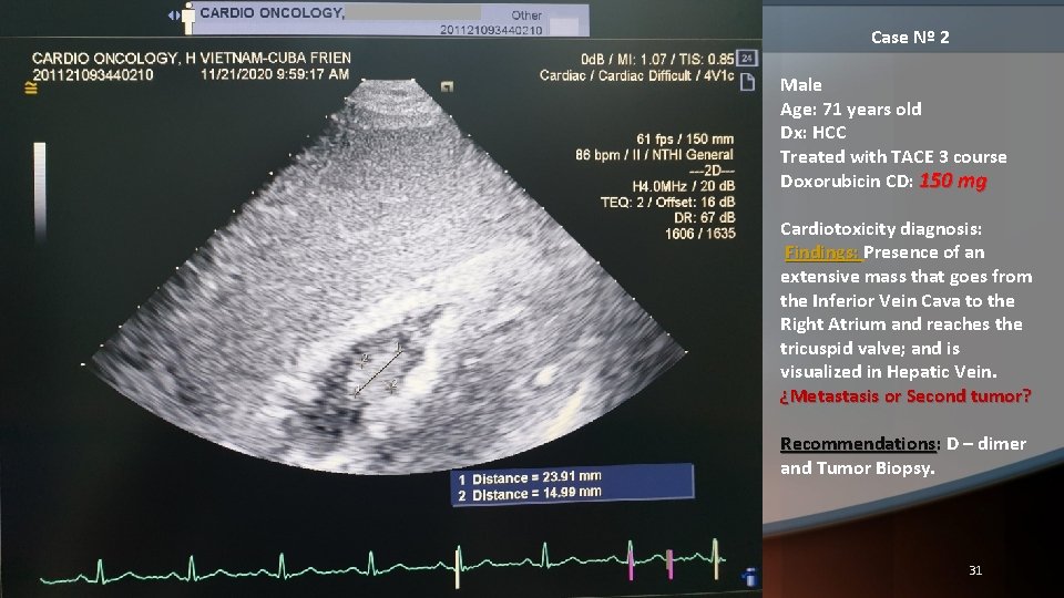 Case Nº 2 Male Age: 71 years old Dx: HCC Treated with TACE 3