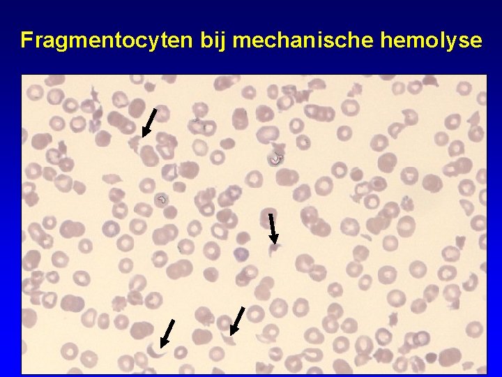 Fragmentocyten bij mechanische hemolyse 
