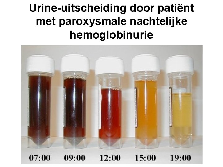 Urine-uitscheiding door patiënt met paroxysmale nachtelijke hemoglobinurie 