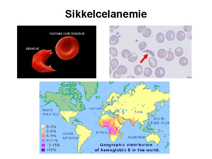Sikkelcelanemie normale rode bloedcel sikkelcel 