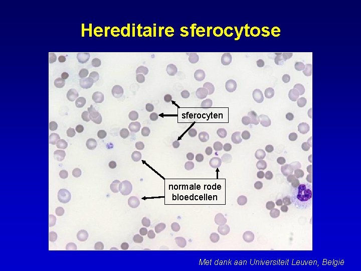 Hereditaire sferocytose sferocyten normale rode bloedcellen Met dank aan Universiteit Leuven, België 