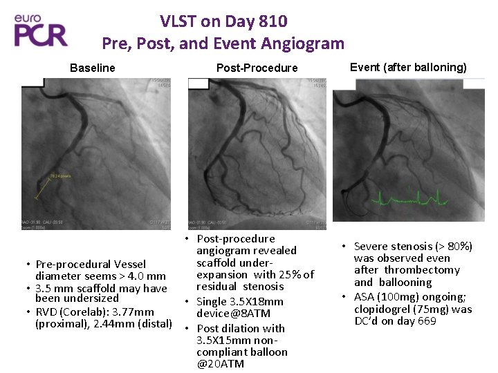 VLST on Day 810 Pre, Post, and Event Angiogram Baseline Post-Procedure • Post-procedure angiogram