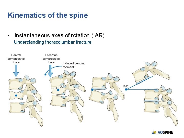 Kinematics of the spine • Instantaneous axes of rotation (IAR) Understanding thoracolumbar fracture 