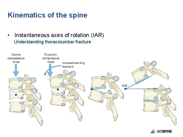 Kinematics of the spine • Instantaneous axes of rotation (IAR) Understanding thoracolumbar fracture 