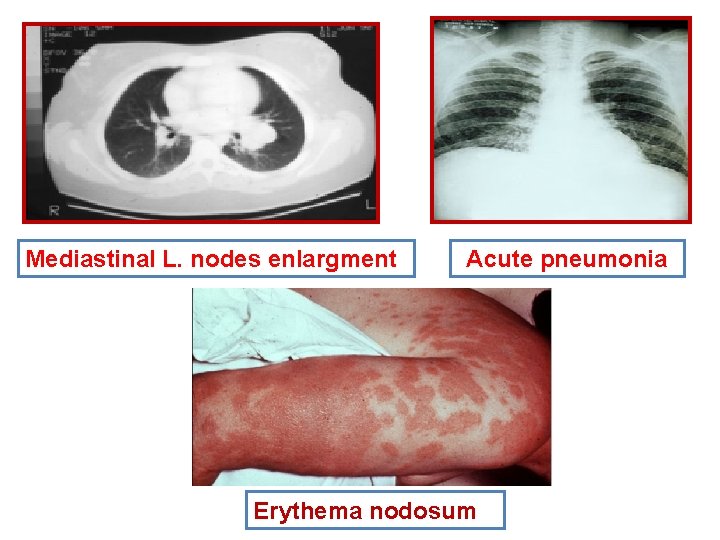 Mediastinal L. nodes enlargment Acute pneumonia Erythema nodosum Mediastinal L. nodes enlargment Acute pneumonia Erythema nodosum