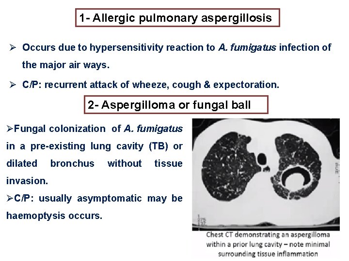 1 - Allergic pulmonary aspergillosis Ø Occurs due to hypersensitivity reaction to A. fumigatus 1 - Allergic pulmonary aspergillosis Ø Occurs due to hypersensitivity reaction to A. fumigatus