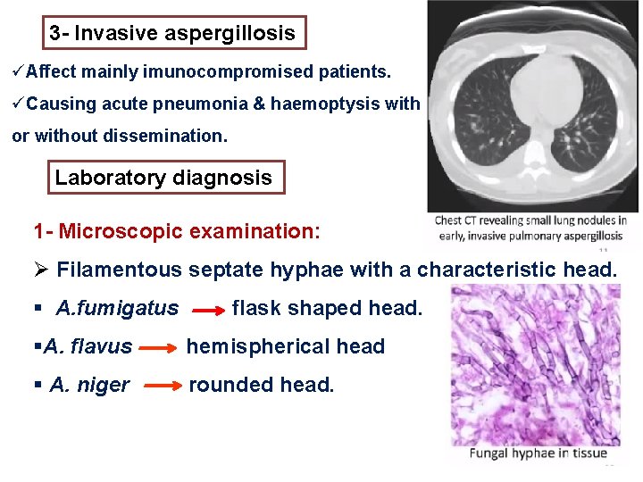 3 - Invasive aspergillosis üAffect mainly imunocompromised patients. üCausing acute pneumonia & haemoptysis with 3 - Invasive aspergillosis üAffect mainly imunocompromised patients. üCausing acute pneumonia & haemoptysis with