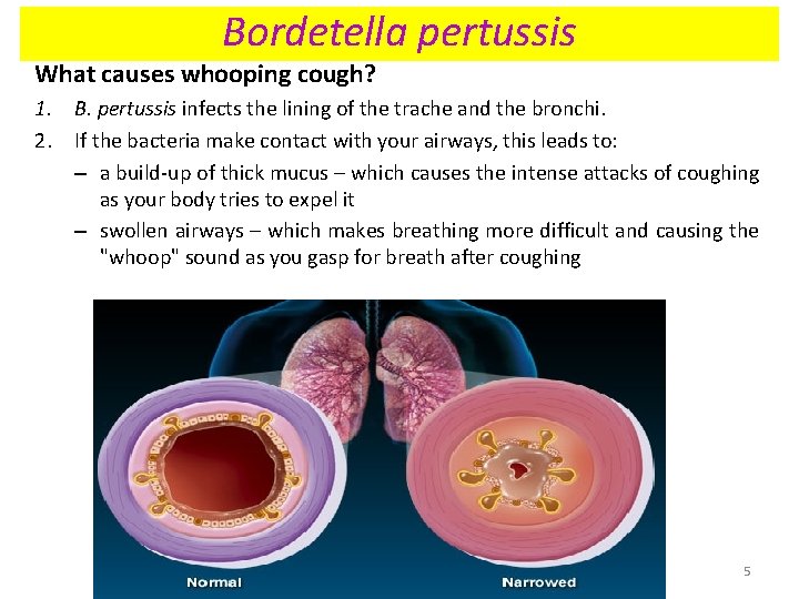 Bordetella pertussis What causes whooping cough? 1. B. pertussis infects the lining of the Bordetella pertussis What causes whooping cough? 1. B. pertussis infects the lining of the