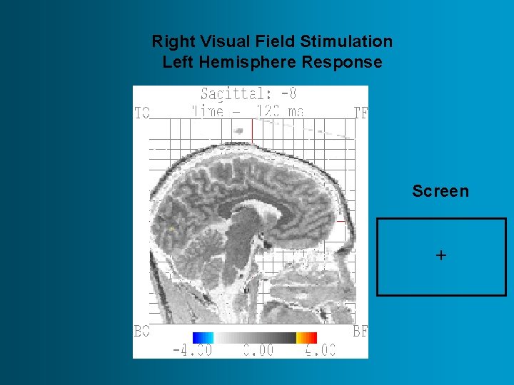 Right Visual Field Stimulation Left Hemisphere Response Screen + 