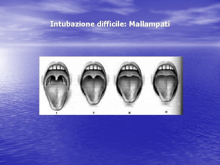 Intubazione difficile: Mallampati 