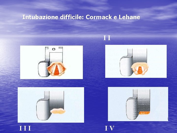 Intubazione difficile: Cormack e Lehane II I III IV 