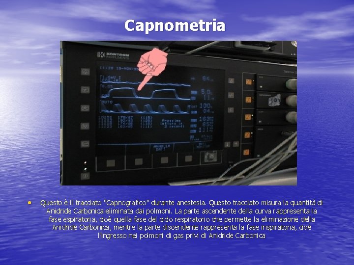 Capnometria • Questo è il tracciato "Capnografico" durante anestesia. Questo tracciato misura la quantità