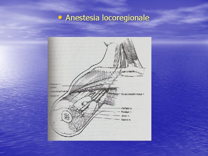  • Anestesia locoregionale 