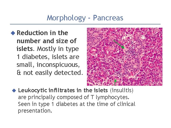 Morphology - Pancreas Reduction in the number and size of islets. Mostly in type