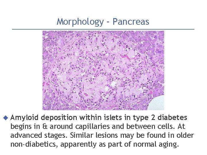 Morphology - Pancreas Amyloid deposition within islets in type 2 diabetes begins in &