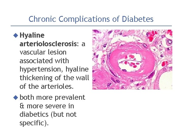 Chronic Complications of Diabetes Hyaline arteriolosclerosis: a vascular lesion associated with hypertension, hyaline thickening