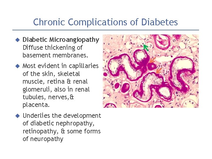 Chronic Complications of Diabetes Diabetic Microangiopathy Diffuse thickening of basement membranes. Most evident in