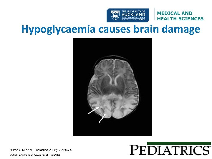 Hypoglycaemia causes brain damage Burns C M et al. Pediatrics 2008; 122: 65 -74