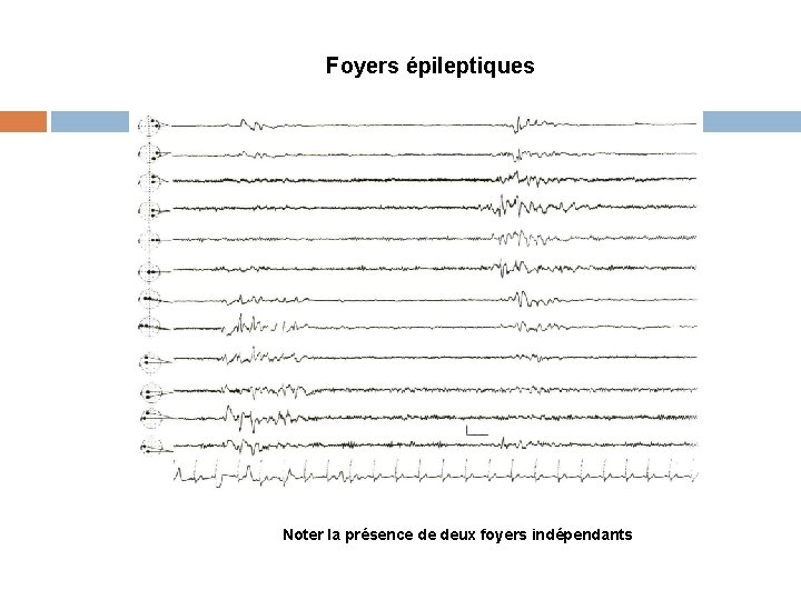 Foyers épileptiques Noter la présence de deux foyers indépendants 