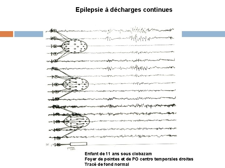 Epilepsie à décharges continues Enfant de 11 ans sous clobazam Foyer de pointes et